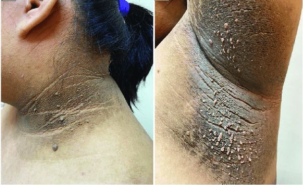 Чёрный акантоз [17]