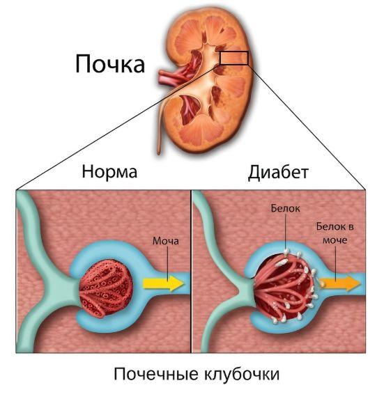 Диабетическая нефропатия
