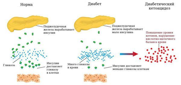 Диабетический кетоацидоз