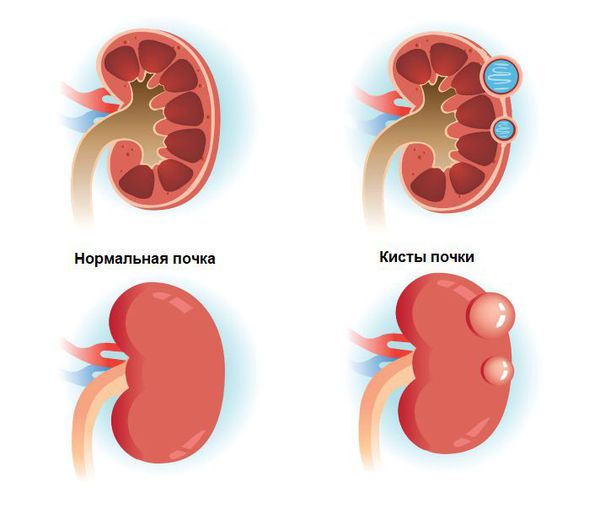 Простая почечная киста