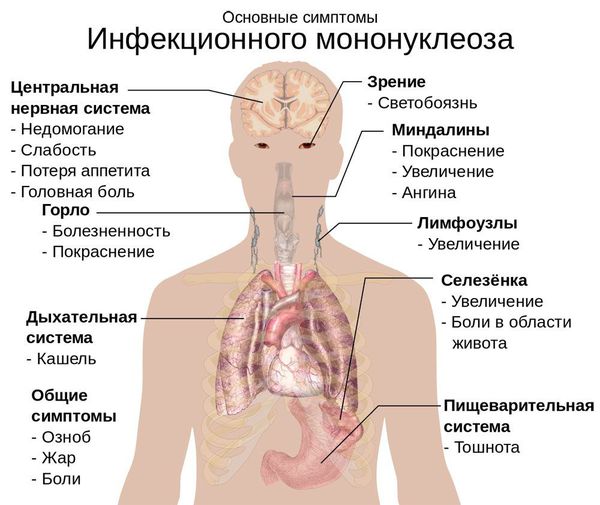 Симптомы инфекционного мононуклеоза