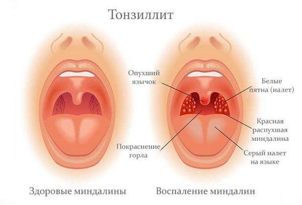 infektivna mononukleoza i bol u zglobovima)