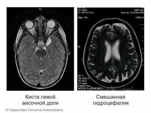 Энцефалопатия (органическое поражение) головного мозга — лечение в Киеве, признаки и причины