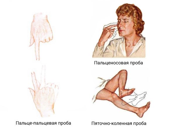 Пробы при диагностике атаксии