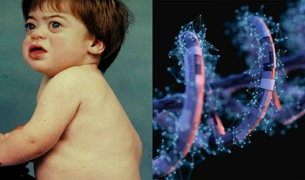 Множественные нарушения строения тела, связанные с генетической мутацией при мукополисахаридозах