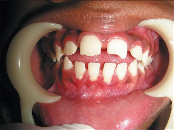 Редкие зубы — один из признаков синдрома Моркио