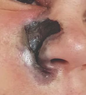 Мукормикоз [18]