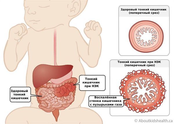 Некротический энтероколит новорождённого