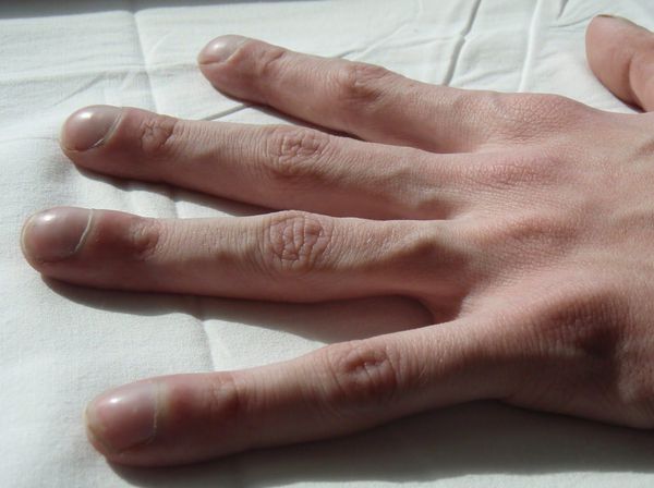 Кисть руки пациента с муковисцидозом