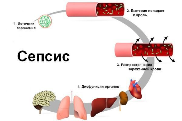 Сепсис Сепсис