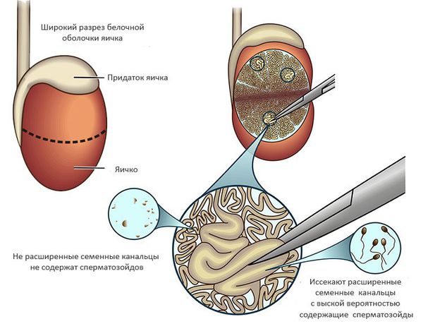 Микрохирургическая биопсия яичек