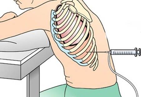 Пункция плевральной полости