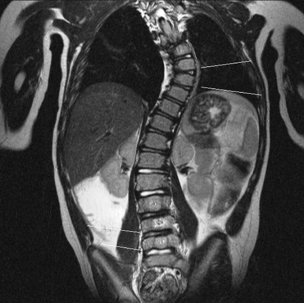 Сколиоз на МРТ [34]