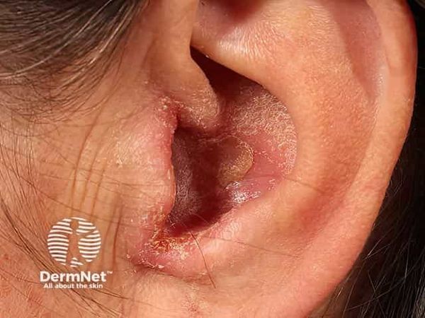 Экзема наружного слухового прохода [13]