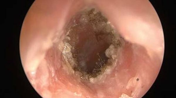 Отомикоз наружного слухового прохода [3]