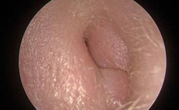 Отёк входа в наружный слуховой проход [3]