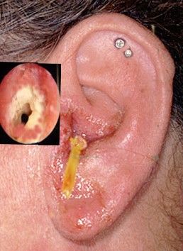 Серозные (прозрачные) и гнойные выделения при наружном отите [2]