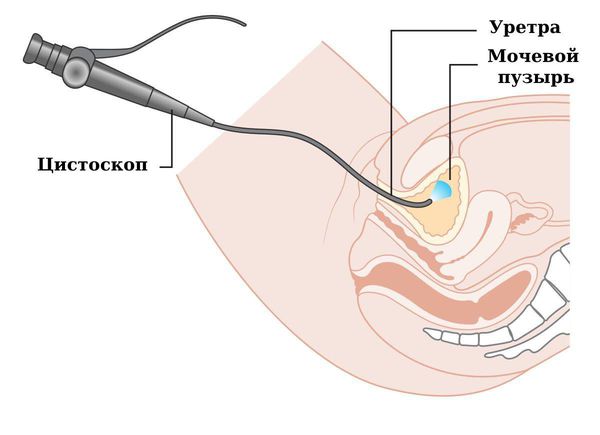 uretrocistoskopiya s