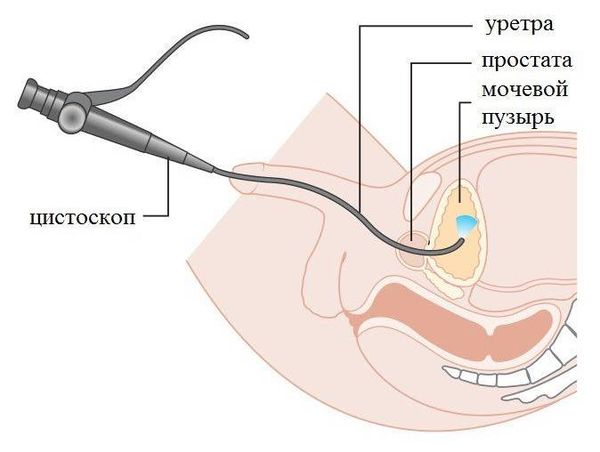 Цистоскопия