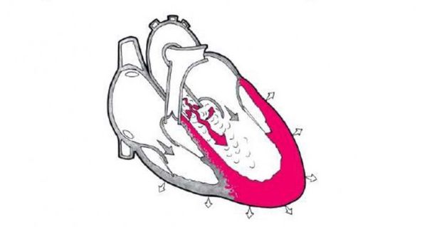 Аортальная конфигурация сердца