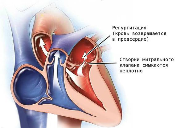 Физиологическая регургитация на клапане легочной артерии и трикуспидальном клапане что это значит