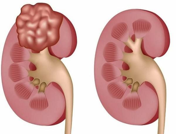 Нефробластома