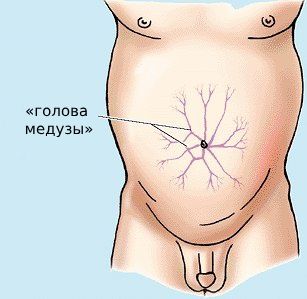 Выбухающие вены («голова медузы»)
