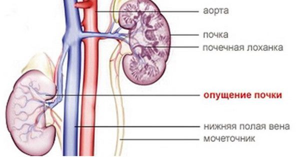 Опущение почки Опущение почки