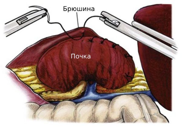 Опущение почки