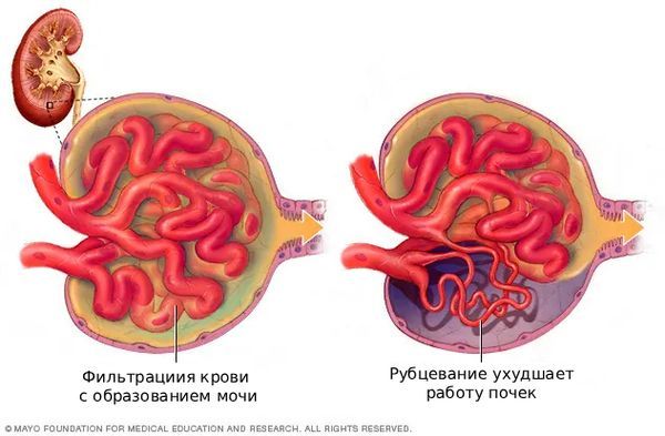 Гломерулосклероз [27]