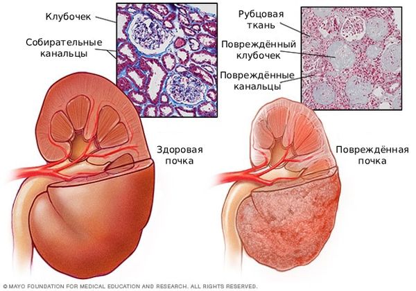Повреждённая почка [26]