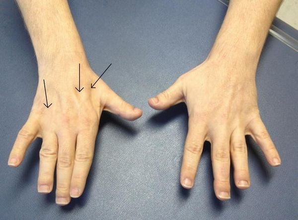 Атрофия мышц кисти [16]