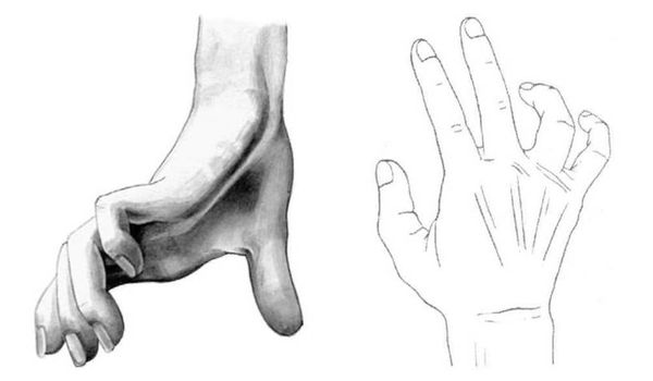 Когтеобразная кисть («когтистая лапа»)