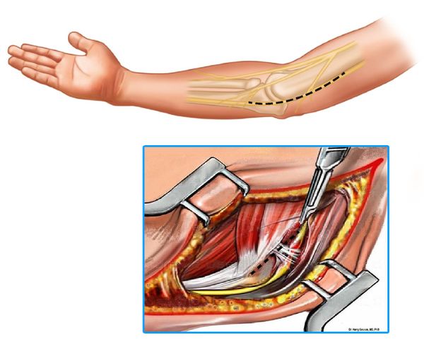 Открытая декомпрессия локтевого нерва