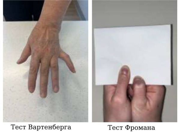 Тест Фромана и Вартенберга