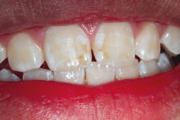 Лечение некариозных поражений зуба