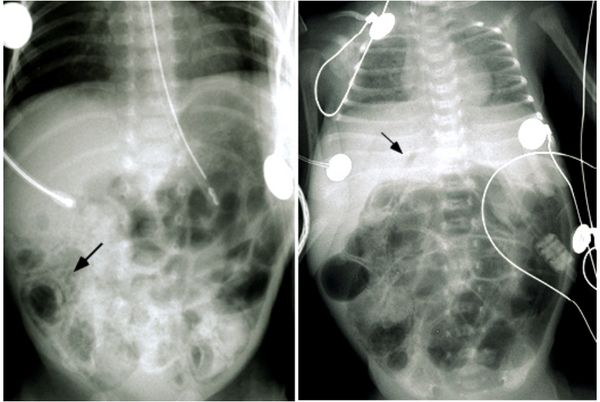 Обширный пневматоз кишечника (слева) и подозрение на газ в системе воротной вены или пневмоперитонеум (справа) [43]