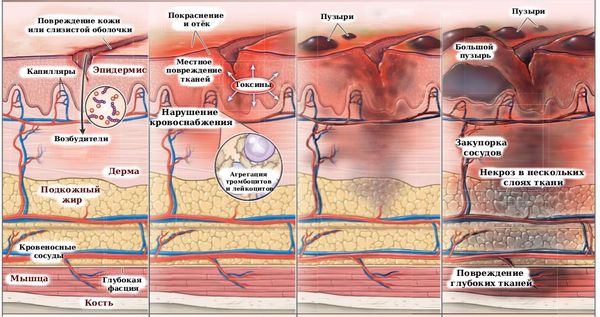 Этапы развития некротизирующей инфекции мягких тканей [25]