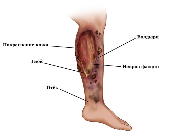 Некротизирующий фасциит [21]