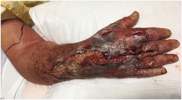 Некроз кожи и фасции [3]