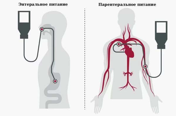 Парентеральное и энтеральное питание