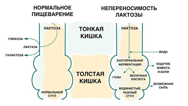 Лактазная недостаточность у детей