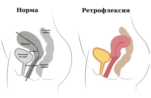 Нормальное положение матки и загиб (ретрофлексия) Нормальное положение матки и загиб (ретрофлексия)