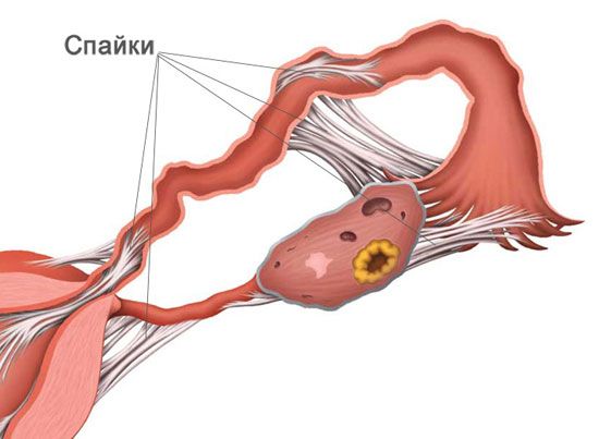Спайки в малом тазу