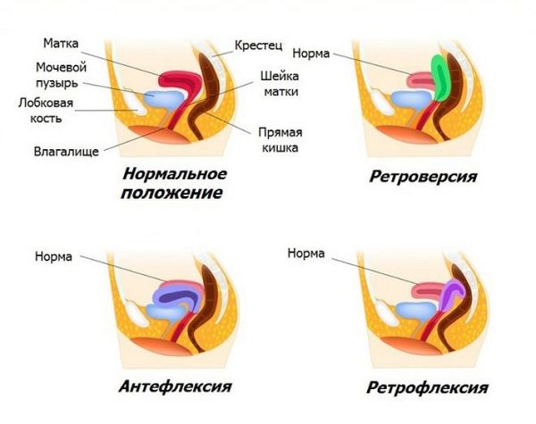 Варианты расположения матки Варианты расположения матки
