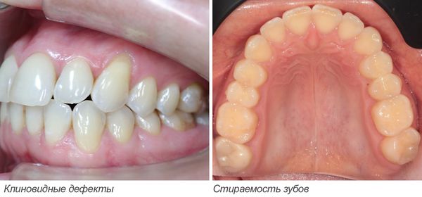 Клиновидные дефекты и стираемость зубов