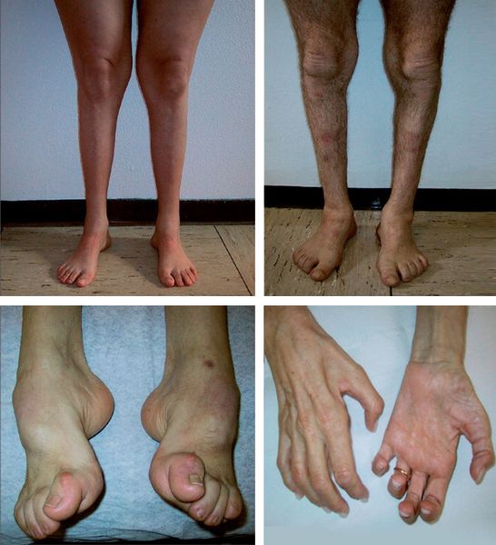 Симптомы амиотрофии Шарко — Мари — Тута [32]