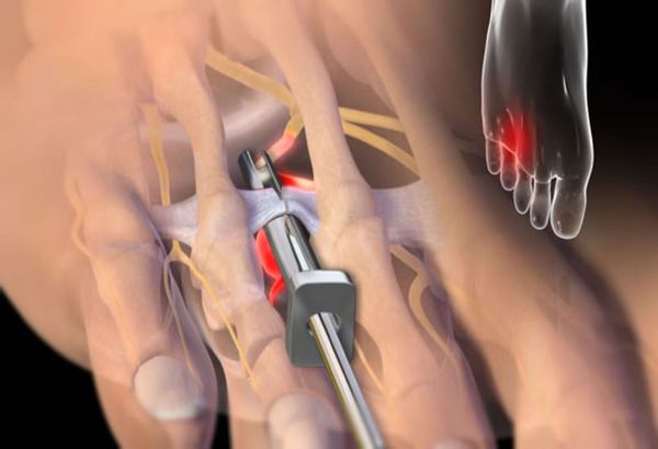 Рассечение межплюсневой связки [12]