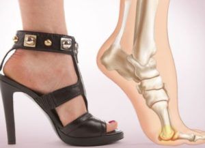 Влияние обуви на высоких каблуках на стопу Влияние обуви на высоких каблуках на стопу