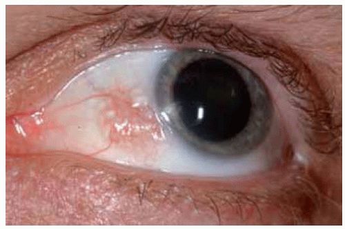 Беспигментный невус конъюнктивы с кистами [22]